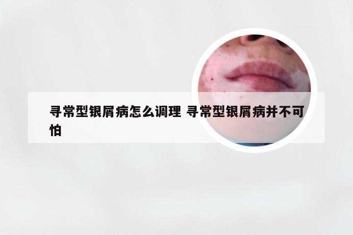 寻常型银屑病怎么调理 寻常型银屑病并不可怕
