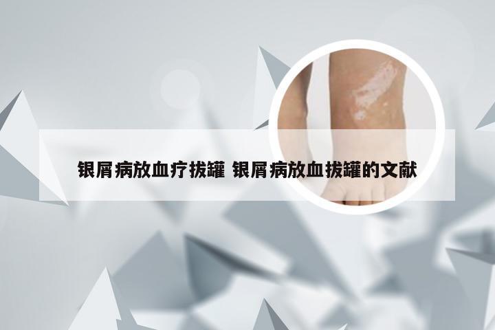 银屑病放血疗拔罐 银屑病放血拔罐的文献