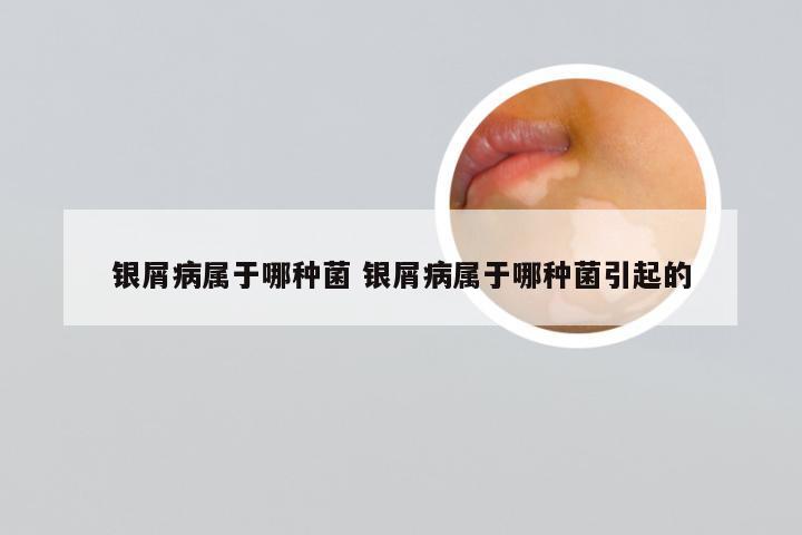 银屑病属于哪种菌 银屑病属于哪种菌引起的