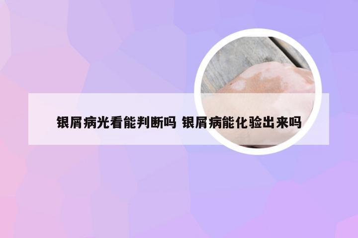 银屑病光看能判断吗 银屑病能化验出来吗