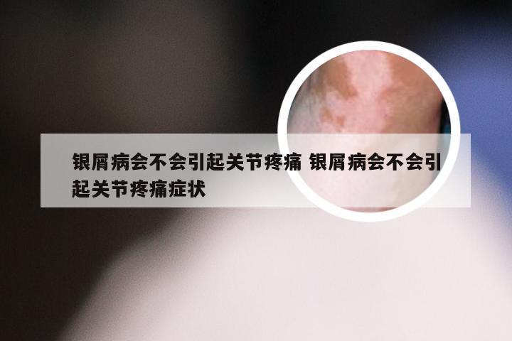 银屑病会不会引起关节疼痛 银屑病会不会引起关节疼痛症状