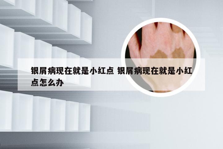 银屑病现在就是小红点 银屑病现在就是小红点怎么办