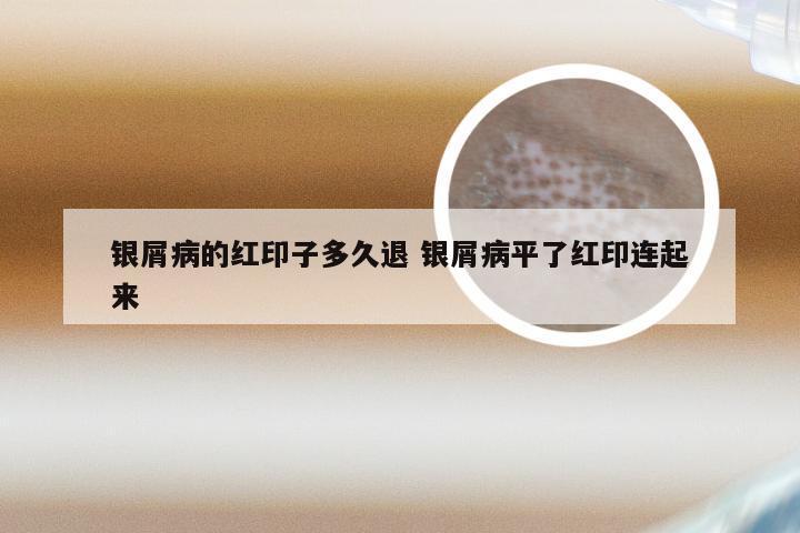 银屑病的红印子多久退 银屑病平了红印连起来