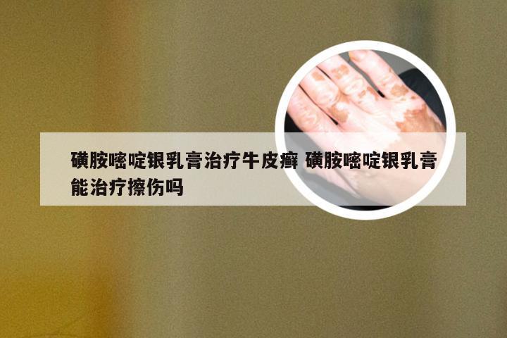 磺胺嘧啶银乳膏治疗牛皮癣 磺胺嘧啶银乳膏能治疗擦伤吗