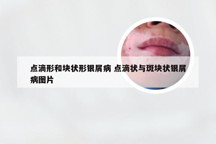 点滴形和块状形银屑病 点滴状与斑块状银屑病图片