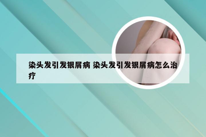 染头发引发银屑病 染头发引发银屑病怎么治疗
