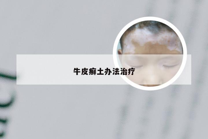 牛皮癣土办法治疗
