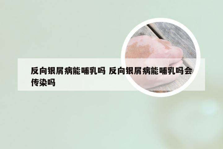 反向银屑病能哺乳吗 反向银屑病能哺乳吗会传染吗