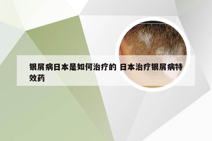 银屑病日本是如何治疗的 日本治疗银屑病特效药