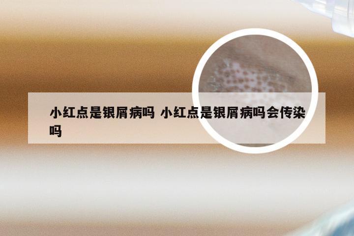 小红点是银屑病吗 小红点是银屑病吗会传染吗