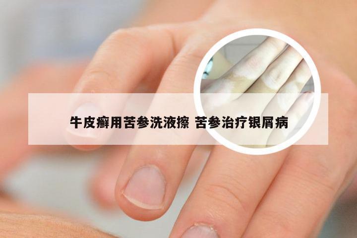 牛皮癣用苦参洗液擦 苦参治疗银屑病