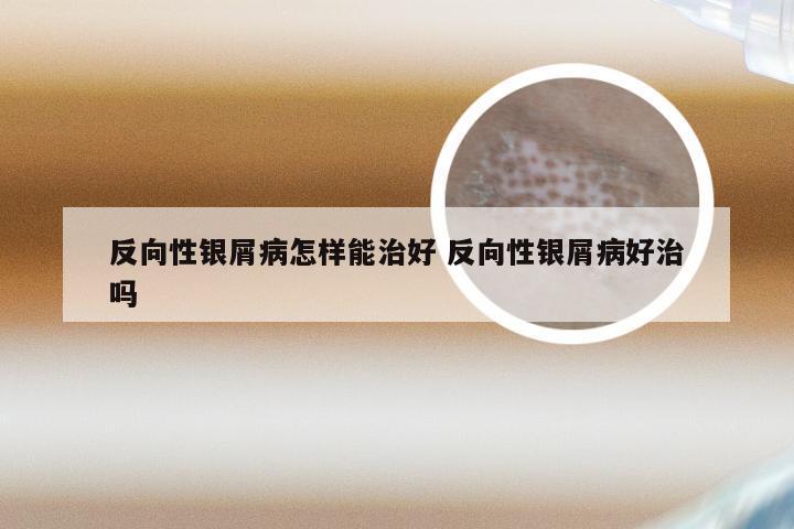 反向性银屑病怎样能治好 反向性银屑病好治吗