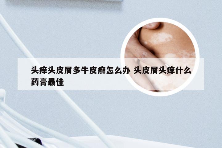 头痒头皮屑多牛皮癣怎么办 头皮屑头痒什么药膏最佳