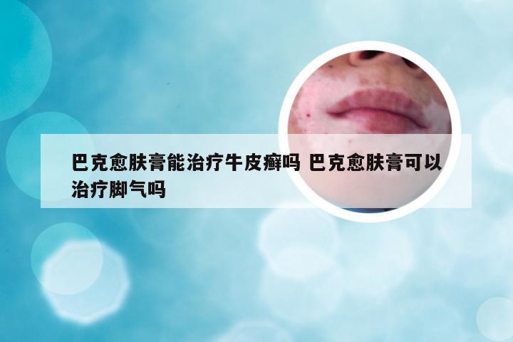 巴克愈肤膏能治疗牛皮癣吗 巴克愈肤膏可以治疗脚气吗