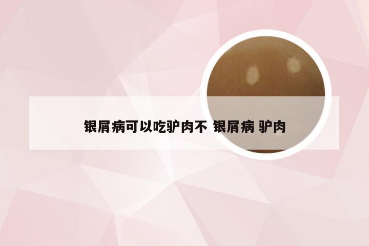 银屑病可以吃驴肉不 银屑病 驴肉
