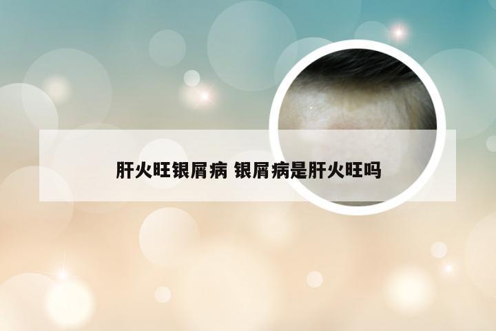 肝火旺银屑病 银屑病是肝火旺吗