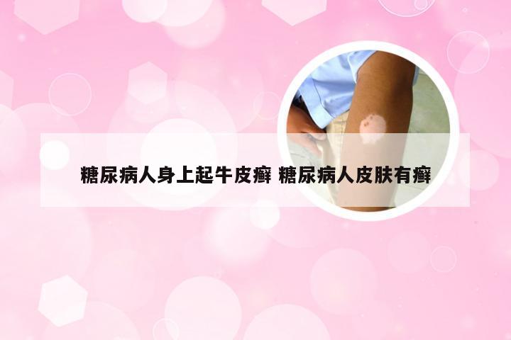 糖尿病人身上起牛皮癣 糖尿病人皮肤有癣