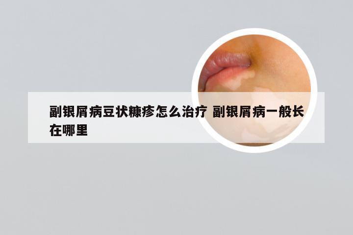 副银屑病豆状糠疹怎么治疗 副银屑病一般长在哪里