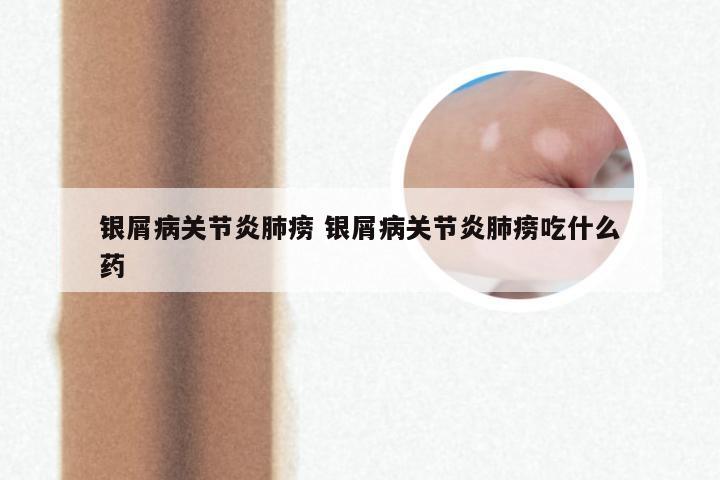 银屑病关节炎肺痨 银屑病关节炎肺痨吃什么药