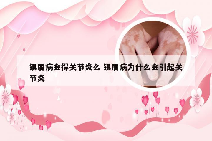 银屑病会得关节炎么 银屑病为什么会引起关节炎