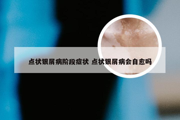 点状银屑病阶段症状 点状银屑病会自愈吗
