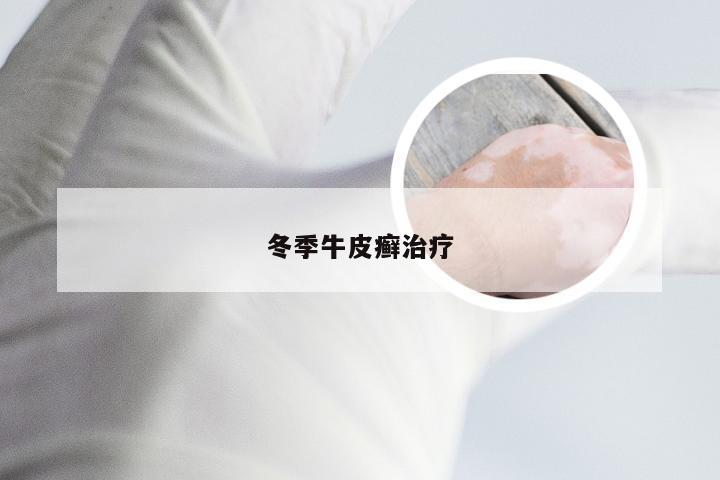 冬季牛皮癣治疗