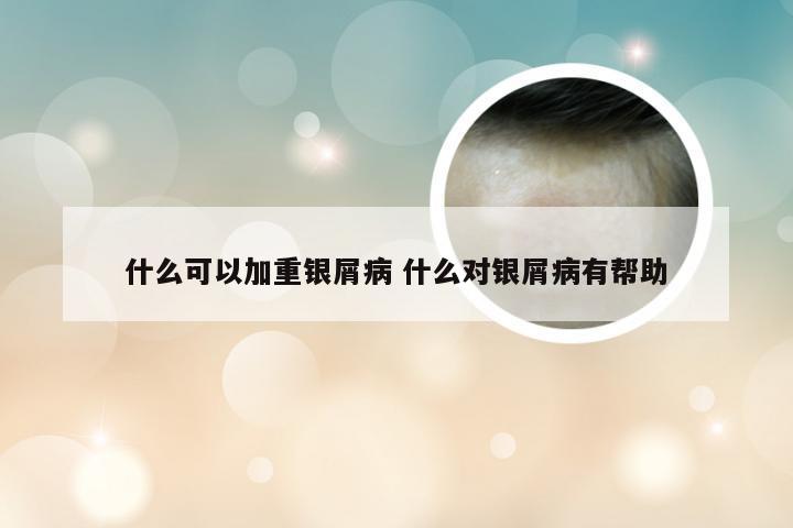 什么可以加重银屑病 什么对银屑病有帮助