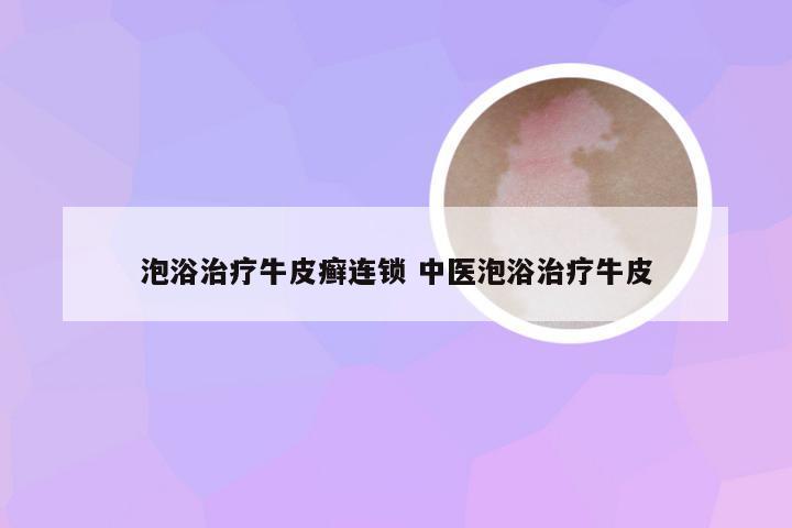 泡浴治疗牛皮癣连锁 中医泡浴治疗牛皮