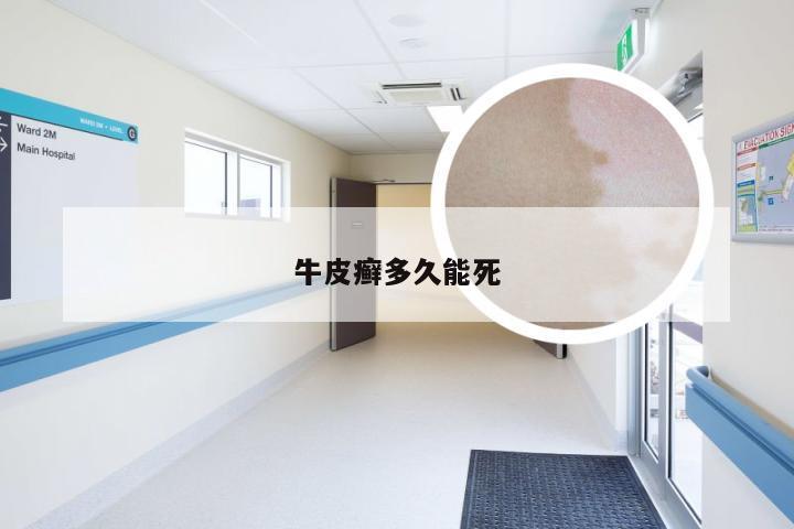 牛皮癣多久能死