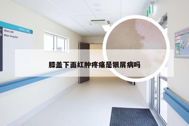 膝盖下面红肿疼痛是银屑病吗