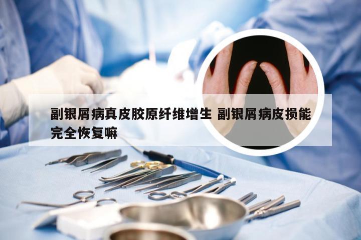 副银屑病真皮胶原纤维增生 副银屑病皮损能完全恢复嘛