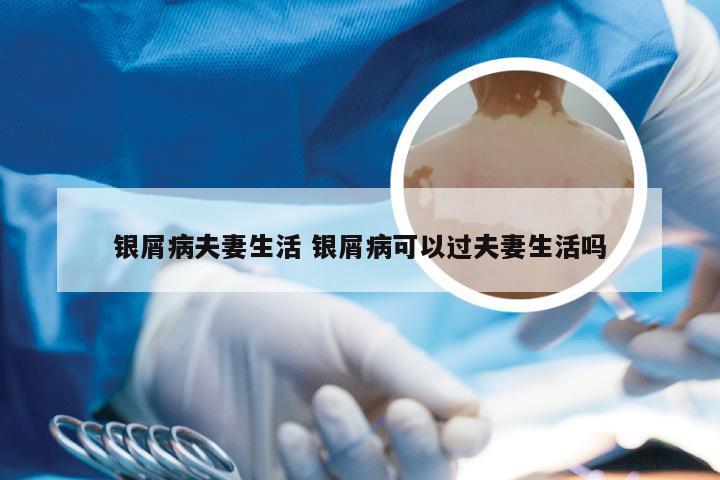 银屑病夫妻生活 银屑病可以过夫妻生活吗