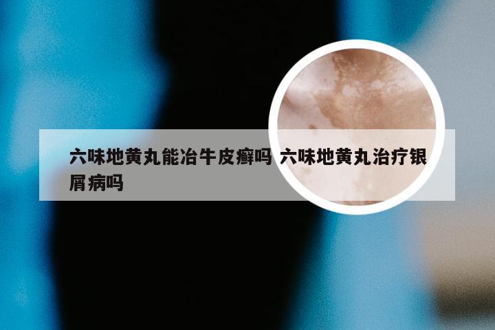 六味地黄丸能冶牛皮癣吗 六味地黄丸治疗银屑病吗
