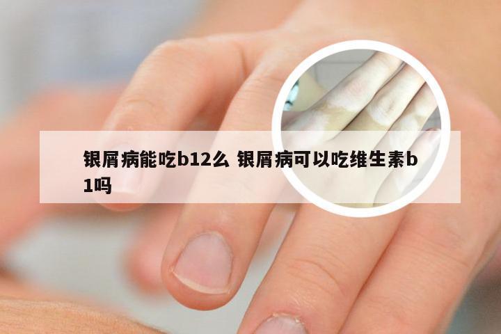 银屑病能吃b12么 银屑病可以吃维生素b1吗