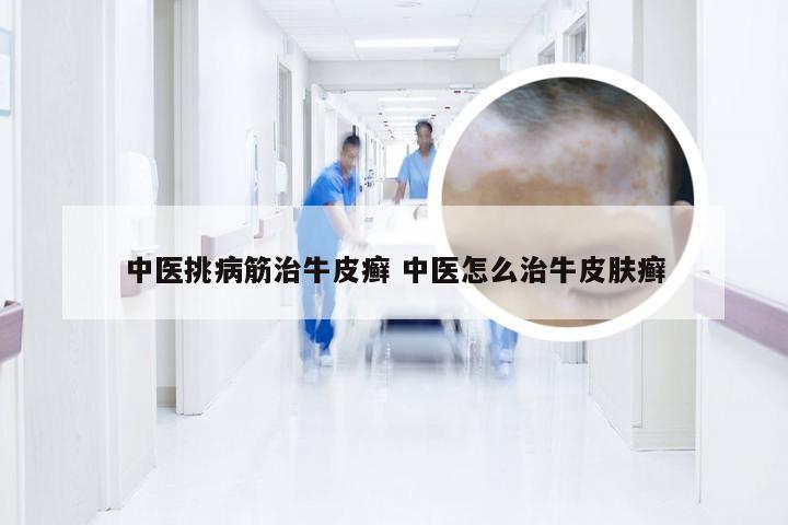 中医挑病筋治牛皮癣 中医怎么治牛皮肤癣
