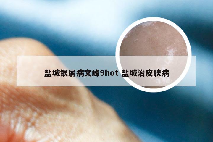 盐城银屑病文峰9hot 盐城治皮肤病