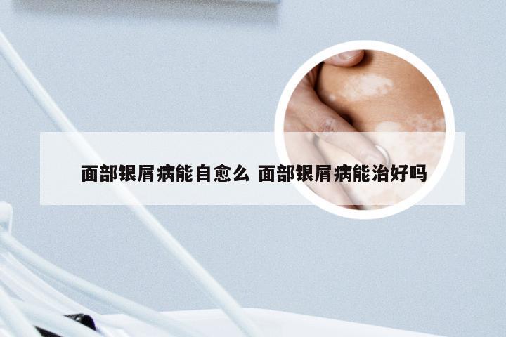 面部银屑病能自愈么 面部银屑病能治好吗