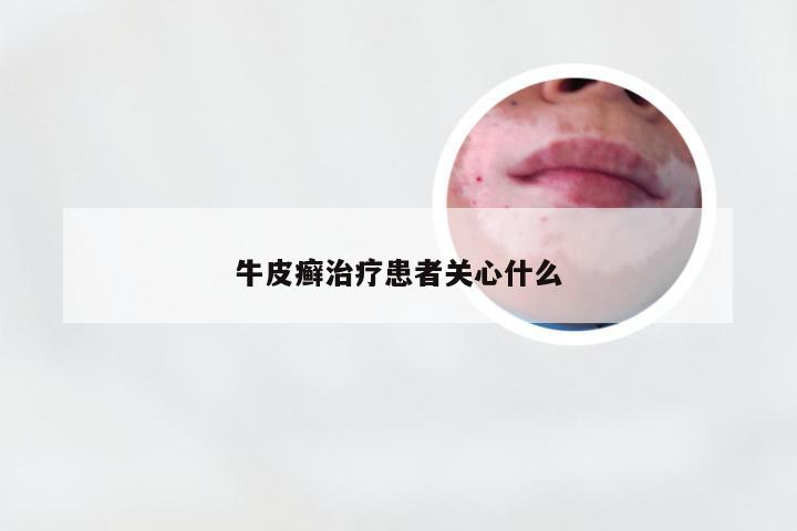 牛皮癣治疗患者关心什么
