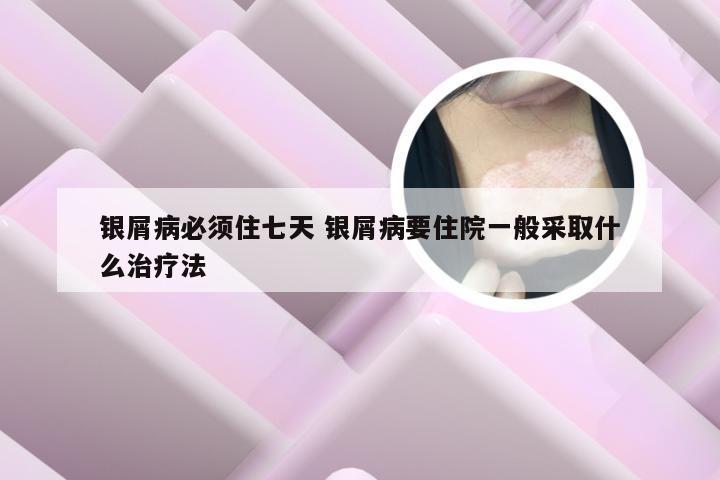 银屑病必须住七天 银屑病要住院一般采取什么治疗法