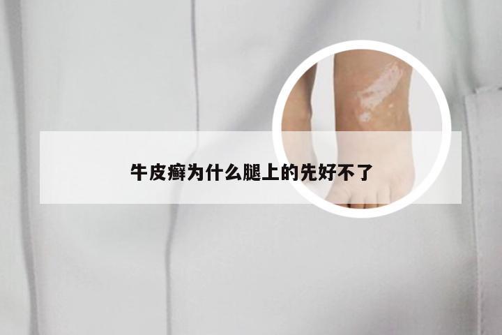 牛皮癣为什么腿上的先好不了