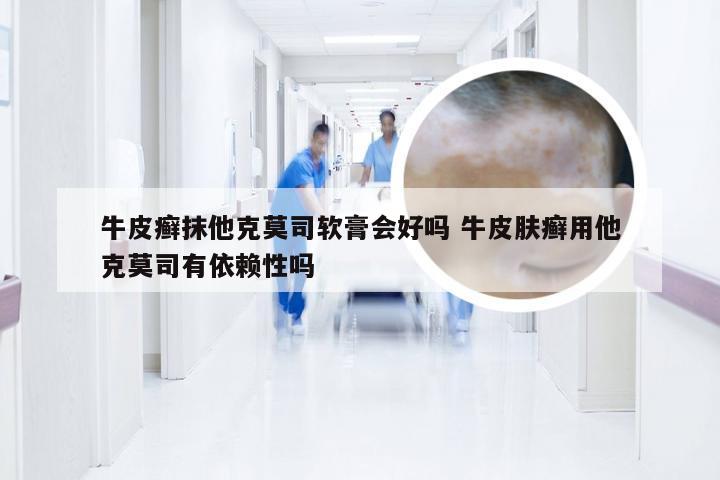 牛皮癣抹他克莫司软膏会好吗 牛皮肤癣用他克莫司有依赖性吗