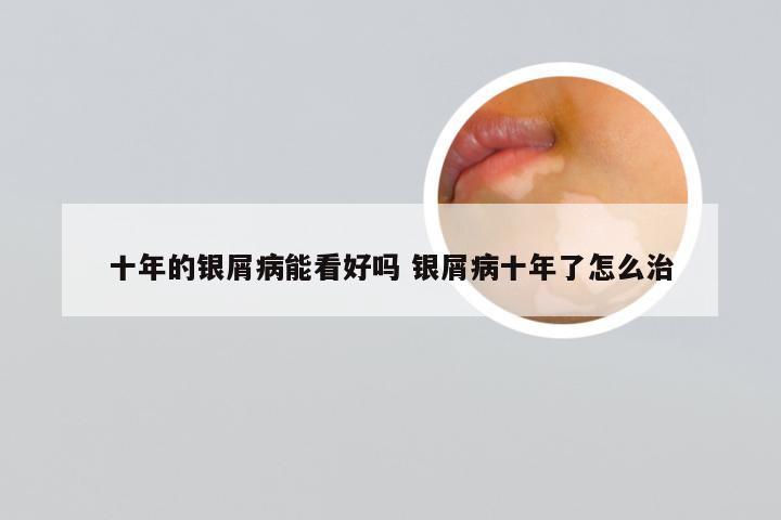 十年的银屑病能看好吗 银屑病十年了怎么治
