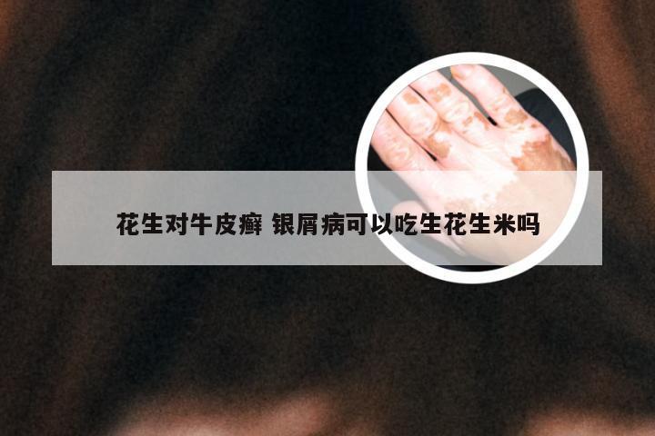 花生对牛皮癣 银屑病可以吃生花生米吗