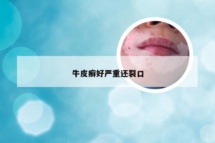 牛皮癣好严重还裂口