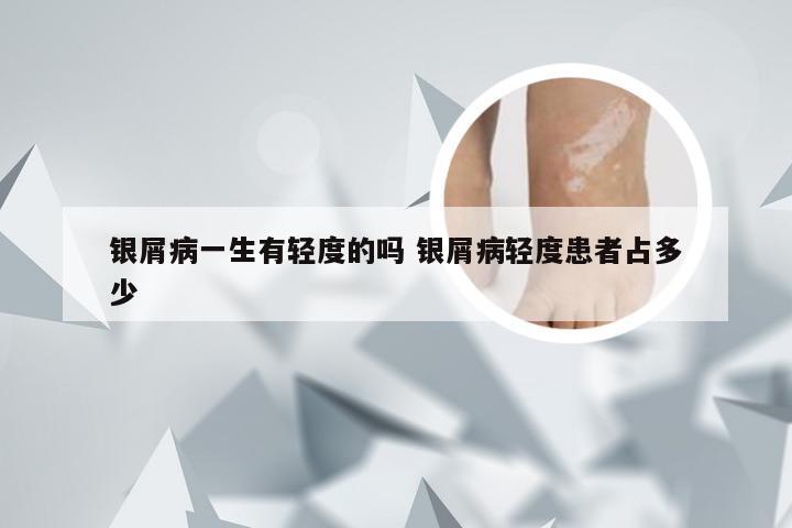 银屑病一生有轻度的吗 银屑病轻度患者占多少