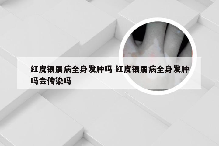 红皮银屑病全身发肿吗 红皮银屑病全身发肿吗会传染吗
