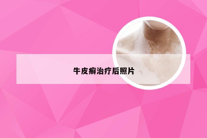 牛皮癣治疗后照片