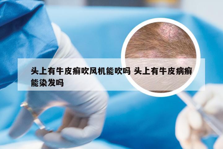 头上有牛皮癣吹风机能吹吗 头上有牛皮病癣能染发吗