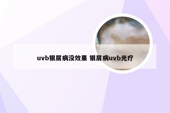 uvb银屑病没效果 银屑病uvb光疗