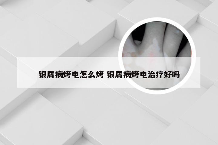 银屑病烤电怎么烤 银屑病烤电治疗好吗